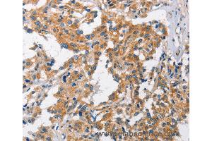 Immunohistochemistry of Human gastric cancer using CHMP1A Polyclonal Antibody at dilution of 1:60 (CHMP1A Antikörper)