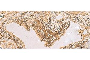 Immunohistochemistry of paraffin-embedded Human prost ate cancer tissue using RAB38 Polyclonal Antibody at dilution of 1:60(x200) (RAB38 Antikörper)