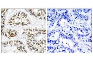 Immunohistochemical analysis of paraffin-embedded human breast carcinoma tissue using RelB(Phospho-Ser573) Antibody(left) or the same antibody preincubated with blocking peptide(right). (RELB Antikörper  (pSer573))