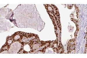 ABIN6267205 at 1/100 staining Human thyroid cancer tissue by IHC-P. (ULK1 Antikörper  (pSer467))