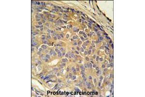 LOH12CR1 Antibody immunohistochemistry analysis in formalin fixed and paraffin embedded human prostate carcinoma followed by peroxidase conjugation of the secondary antibody and DAB staining. (LOH12CR1 Antikörper  (C-Term))