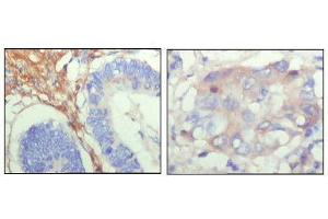 Immunohistochemical analysis of paraffin-embedded human colon cancer (left) and breast cancer (right) showing cytoplasmic localization with DAB staining using FBLN5 mouse mAb. (Fibulin 5 Antikörper  (AA 242-448))