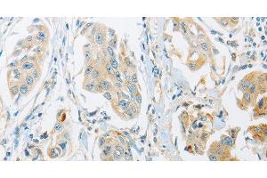 Immunohistochemistry of paraffin-embedded Human breast cancer tissue using ARHGEF10 Polyclonal Antibody at dilution 1:45 (ARHGEF10 Antikörper)