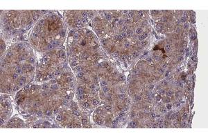 ABIN6273983 at 1/100 staining Human liver cancer tissue by IHC-P. (OR2T6 Antikörper  (C-Term))