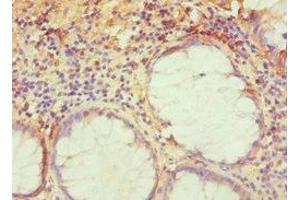 Immunohistochemistry of paraffin-embedded human colon cancer using ABIN7143276 at dilution of 1:100 (TRAF3IP2 Antikörper  (AA 1-300))