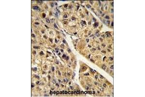 Formalin-fixed and paraffin-embedded human hepatocarcinoma reacted with PEX11A Antibody (N-term), which was peroxidase-conjugated to the secondary antibody, followed by DAB staining. (PEX11A Antikörper  (N-Term))