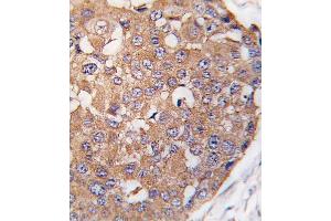 Formalin-fixed and paraffin-embedded human breast carcinoma tissue reacted with SNK Antibody (C-term ) (ABIN391375 and ABIN2841386) , which was peroxidase-conjugated to the secondary antibody, followed by DAB staining. (PLK2 Antikörper  (C-Term))
