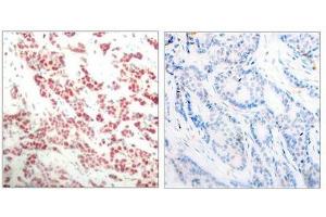 Immunohistochemical analysis of paraffin- embedded human breast carcinoma tissue using NF-κ,B p100 (phospho- ser866) antibody. (NFKB2 Antikörper  (pSer866))