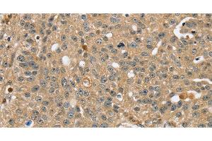 Immunohistochemistry of paraffin-embedded Human breast cancer using RNH1 Polyclonal Antibody at dilution of 1:40 (RNH1 Antikörper)