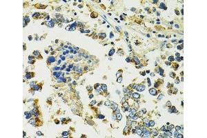 Immunohistochemistry of paraffin-embedded Human colon carcinoma using SLC25A11 Polyclonal Antibody at dilution of 1:100 (40x lens). (SLC25A11 Antikörper)