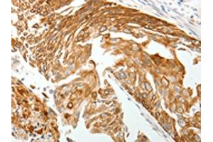 The image on the left is immunohistochemistry of paraffin-embedded Human cervical cancer tissue using ABIN7192814(TMSB10 Antibody) at dilution 1/15, on the right is treated with synthetic peptide. (Thymosin beta 10 Antikörper)