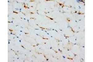 Immunohistochemical analysis of paraffin-embedded rectal carcinoma sections, stain GJA1 in cytoplasm DAB chromogenic reaction.