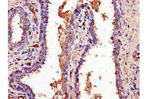 Immunohistochemistry of paraffin-embedded human prostate cancer using ABIN7164882 at dilution of 1:100 (PCOTH Antikörper  (AA 50-100))
