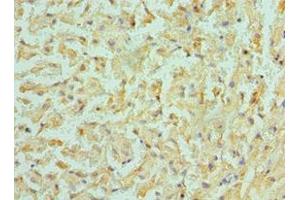 Immunohistochemistry of paraffin-embedded human liver cancer using ABIN7145312 at dilution of 1:100 (BMF Antikörper  (AA 1-184))