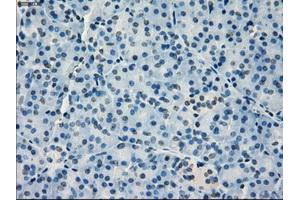 Immunohistochemical staining of paraffin-embedded Adenocarcinoma of breast tissue using anti-IRF3 mouse monoclonal antibody. (IRF3 Antikörper)