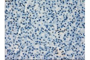 Immunohistochemical staining of paraffin-embedded Adenocarcinoma of breast tissue using anti-IRF3 mouse monoclonal antibody. (IRF3 Antikörper)