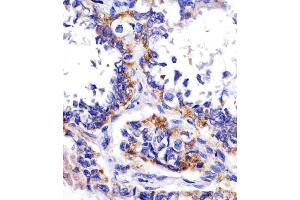 (ABIN390207 and ABIN2840690) staining DDIT4 in human lung adenocarcinoma tissue sections by Immunohistochemistry (IHC-P - paraformaldehyde-fixed, paraffin-embedded sections). (DDIT4 Antikörper  (N-Term))