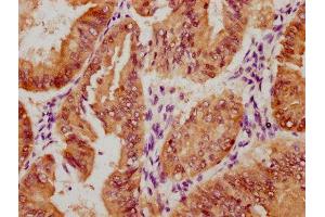 IHC image of ABIN7127761 diluted at 1:100 and staining in paraffin-embedded human endometrial cancer performed on a Leica BondTM system. (Rekombinanter YAP1 Antikörper  (pSer127))
