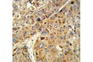 Immunohistochemistry analysis of human hepatocarcinoma tissue (Formalin-fixed, Paraffin-embedded) using Glutathione peroxidase 1 / GPX1  Antibody (C-term), followed by peroxidase-conjugated secondary antibody and DAB staining. (Glutathione Peroxidase 1 Antikörper  (C-Term))