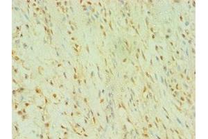 Immunohistochemistry of paraffin-embedded human breast cancer using ABIN7174010 at dilution of 1:100