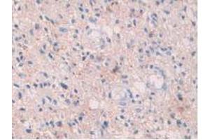 IHC-P analysis of Human Glioma Tissue, with DAB staining. (HIF1A Antikörper  (AA 218-506))
