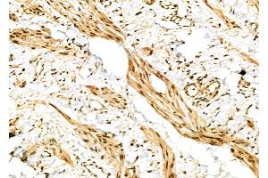 ABIN6264356 and ABIN6277009 at 1/100 staining Human ovarian cancer and adjacent normal tissues by IHC-P.