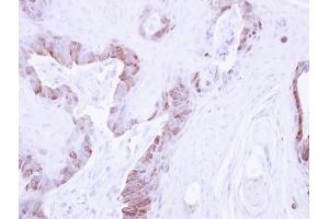 IHC-P Image Immunohistochemical analysis of paraffin-embedded CA922 xenograft , using LIM kinase 2, antibody at 1:500 dilution. (LIMK2 Antikörper)