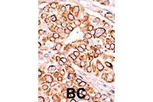 Formalin-fixed and paraffin-embedded human cancer tissue reacted with the primary antibody, which was peroxidase-conjugated to the secondary antibody, followed by AEC staining. (PIKFYVE Antikörper  (AA 1531-1561))