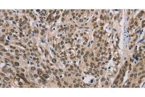 Immunohistochemistry of paraffin-embedded Human esophagus cancer using IRF9 Polyclonal Antibody at dilution of 1:50 (IRF9 Antikörper)