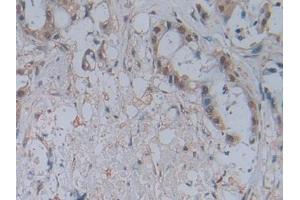 IHC-P analysis of Human Pancreatic cancer Tissue, with DAB staining. (CCL2 Antikörper)