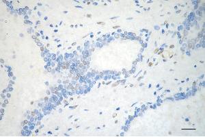 Immunohistochemistry was performed on paraffin-embedded human prostatic adenocarcinoma using PML antibody (ABIN7799924), 1:200). (PML Antikörper)