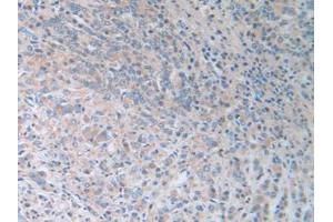 IHC-P analysis of Human Prostate Gland Cancer Tissue, with DAB staining. (SERPINB9 Antikörper  (AA 1-376))