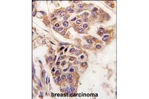 Formalin-fixed and paraffin-embedded human breast carcinoma tissue reacted with C8orf32 antibody (Center), which was peroxidase-conjugated to the secondary antibody, followed by DAB staining. (WDYHV1 Antikörper  (AA 106-136))