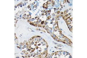 Immunohistochemistry of paraffin-embedded human thyroid cancer using PRC1 Rabbit pAb (ABIN6128502, ABIN6146124, ABIN6146125 and ABIN6222808) at dilution of 1:100 (40x lens). (PRC1 Antikörper  (AA 351-620))