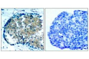 Immunohistochemical analysis of paraffin-embedded human breast carcinoma tissue using Ezrin(Phospho-Tyr353) Antibody(left) or the same antibody preincubated with blocking peptide(right). (Ezrin Antikörper  (pTyr353))