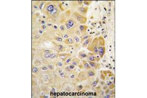 Formalin-fixed and paraffin-embedded human hepatocarcinoma tissue reacted with ALDH2 antibody , which was peroxidase-conjugated to the secondary antibody, followed by DAB staining. (ALDH2 Antikörper  (AA 318-347))