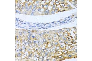 Immunohistochemistry of paraffin-embedded human prostate cancer using BMP4 antibody (ABIN5997308) at dilution of 1/100 (40x lens). (BMP4 Antikörper)