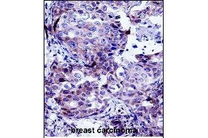 CTTN Antibody (Center) (ABIN657649 and ABIN2846644) immunohistochemistry analysis in formalin fixed and paraffin embedded human breast carcinoma followed by peroxidase conjugation of the secondary antibody and DAB staining. (Cortactin Antikörper  (AA 273-302))