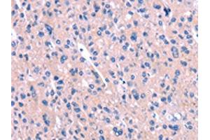 The image on the left is immunohistochemistry of paraffin-embedded Human liver cancer tissue using ABIN7190562(ENPP4 Antibody) at dilution 1/15, on the right is treated with synthetic peptide. (ENPP4 Antikörper)