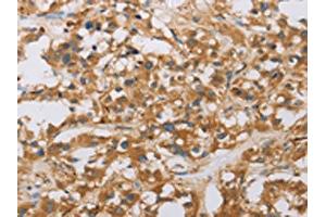 The image on the left is immunohistochemistry of paraffin-embedded Human thyroid cancer tissue using ABIN7130805(RAD54L2 Antibody) at dilution 1/40, on the right is treated with fusion protein. (ARIP4 Antikörper)
