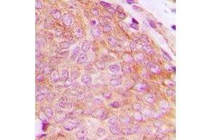 Immunohistochemical analysis of CHKB staining in human breast cancer formalin fixed paraffin embedded tissue section. (CHKB Antikörper  (C-Term))