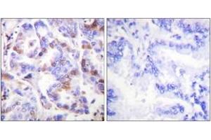 Immunohistochemistry analysis of paraffin-embedded human lung carcinoma, using RFA2 (Phospho-Thr21) Antibody.