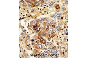 Formalin-fixed and paraffin-embedded human hepatocarcinoma with C Antibody (N-term), which was peroxidase-conjugated to the secondary antibody, followed by DAB staining. (CD163 Antikörper  (N-Term))