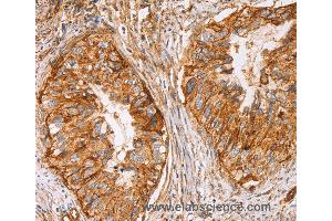Immunohistochemistry of Human cervical cancer using CD59 Polyclonal Antibody at dilution of 1:50 (CD59 Antikörper)