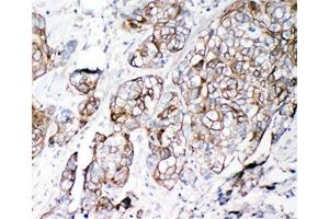 IHC-P: VE-Cadherin antibody testing of human lung cancer tissue