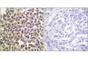 Immunohistochemistry analysis of paraffin-embedded human breast carcinoma, using p130 Cas (Phospho-Tyr249) Antibody. (BCAR1 Antikörper  (pTyr249))
