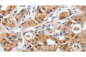 Immunohistochemistry of paraffin-embedded Human lung cancer using 14-3-3 epsilon Polyclonal Antibody at dilution of 1:100 (YWHAE Antikörper)