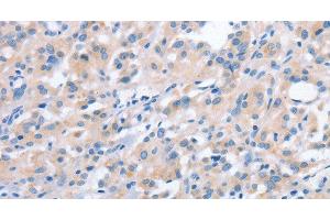 Immunohistochemistry of paraffin-embedded Human thyroid cancer using NCAPD2 Polyclonal Antibody at dilution of 1:40 (NCAPD2 Antikörper)