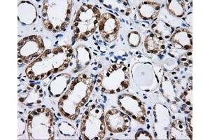 Immunohistochemical staining of paraffin-embedded Adenocarcinoma of ovary tissue using anti-CISD1mouse monoclonal antibody. (CISD1 Antikörper)