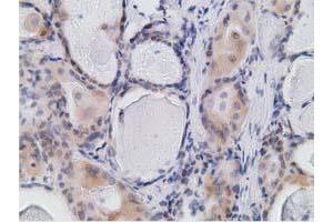 Immunohistochemical staining of paraffin-embedded Carcinoma of Human thyroid tissue using anti-RBBP9 mouse monoclonal antibody.